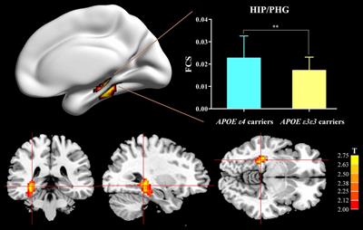 Apolipoprotein E ε4 Specifically Modulates the Hippocampus Functional Connectivity Network in Patients With Amnestic Mild Cognitive Impairment